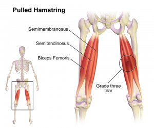 Chấn thương cơ gân kheo - Hình ảnh minh họa